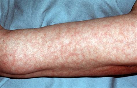 manchas en la piel por anemia-1